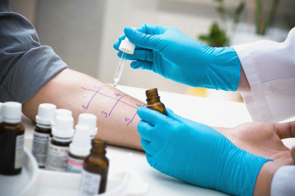 Doctor testing a patient for allergies with a teet pipette and wearing glatex gloves.